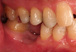 臼歯中間歯欠損インプラント治療前