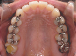 審美歯科症例冠治療前